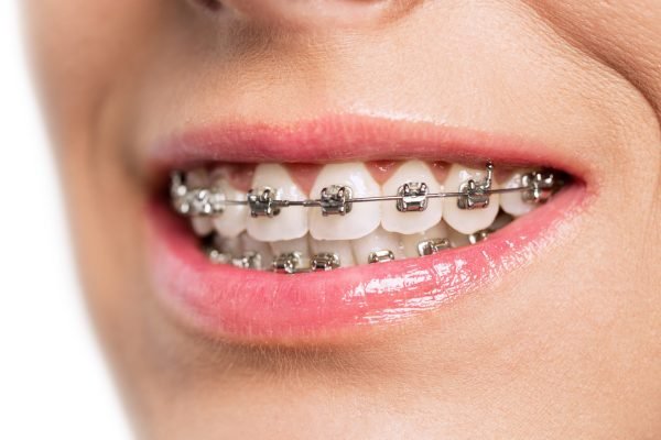 Teeth,With,Braces,Isolated,On,White