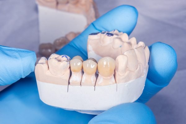 ceramic crowns veneers on a gypsum model of human teeth close-up macro in the dentist's hand in a blue glove.